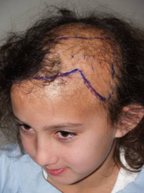 Surgical markings outlining the planned hairline before a pediatric hair restoration procedure.