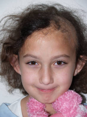 Young patient before hair restoration showing hair loss along the front and side of the scalp.