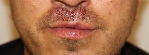 Close-up of the upper lip immediately after a hair transplant with newly implanted grafts visible.