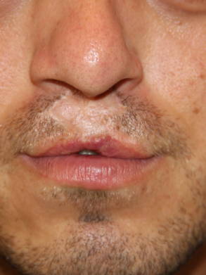 Close-up of the upper lip during the healing process following a hair transplant procedure.