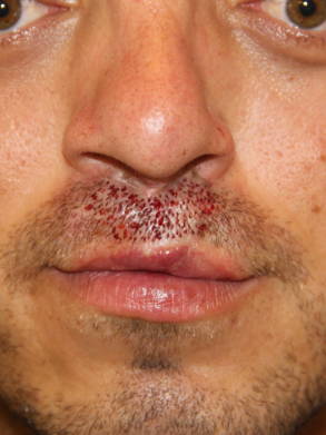 Healing progress following an upper lip hair transplant showing newly implanted grafts and early recovery.