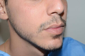 Close-up of a man's cheek and jawline showing fuller beard growth after beard restoration.