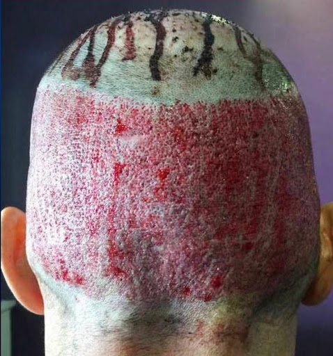 Close-up of a freshly transplanted scalp with newly implanted hair grafts.