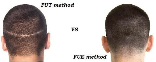 Comparison of FUT and FUE hair transplant donor harvesting methods shown from the back of the head.
