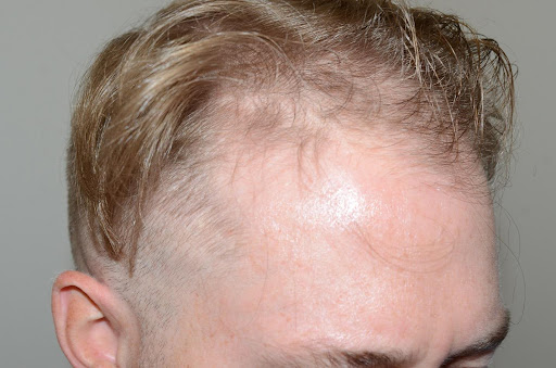Close-up of a man's receding hairline with visible thinning at the temples.