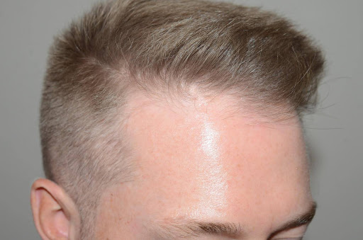 Close-up of a man's hairline showing natural hair density after restoration.