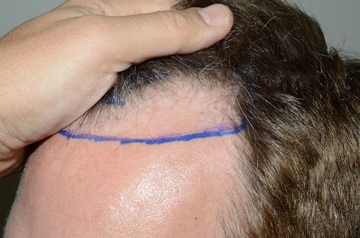 Close-up of a man's hairline marked for a planned hair restoration procedure.
