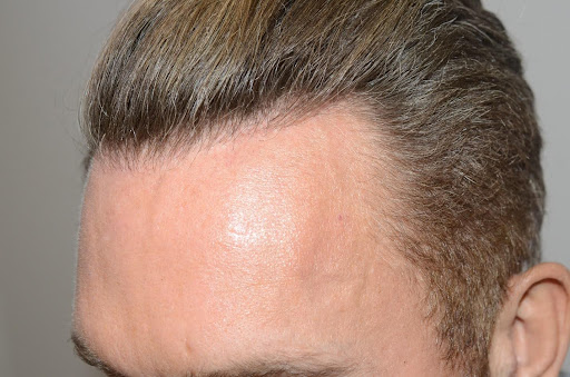 Close-up of a man's restored hairline viewed from the front and side.