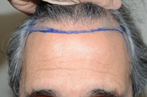 Close-up of a man's hairline marked for a planned hair restoration procedure.