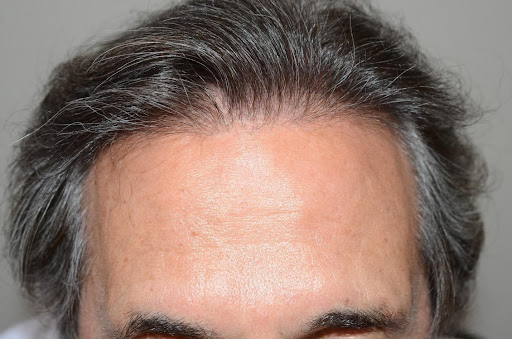 Close-up of a man's hairline showing frontal hair thinning.