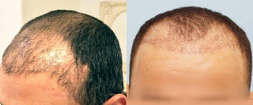 Before and after photos showing hair transplant results with improved hair density.