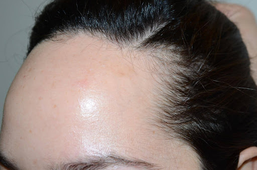 Close-up of a woman's temple with hair pulled back to reveal hairline recession.