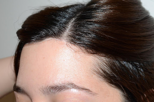 Close-up of a woman's temple showing thinning hair along the hairline.