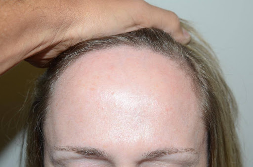 Close-up of a woman's receding hairline with hair pulled back for examination.