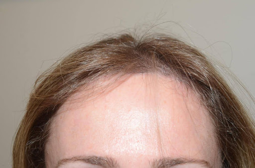Close-up of a woman's forehead and thinning frontal hairline.