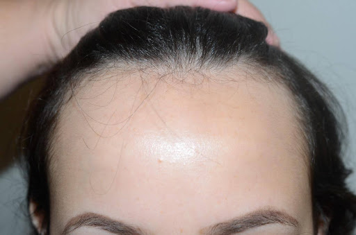 Close-up of a woman's receding hairline with hair pulled back to reveal thinning.