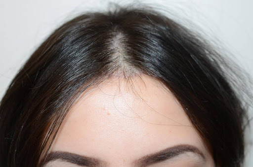 Close-up of a woman's scalp showing a widened hair part and thinning hair.