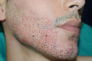 Close-up of a man's cheek and jaw immediately after a beard transplant procedure showing newly implanted grafts.