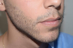 Close-up of a man's cheek and jawline with natural beard growth.