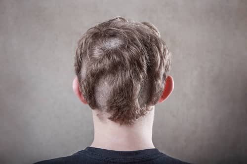 Back view of a teenager's head showing an uneven hair growth pattern.