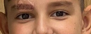 Close-up of a young patient's healing eyebrow incision during the early stages of recovery.